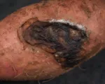 Ceratocystis Wilt, Canker, and Black Rot