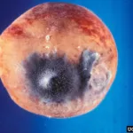 Rhizopus soft rot